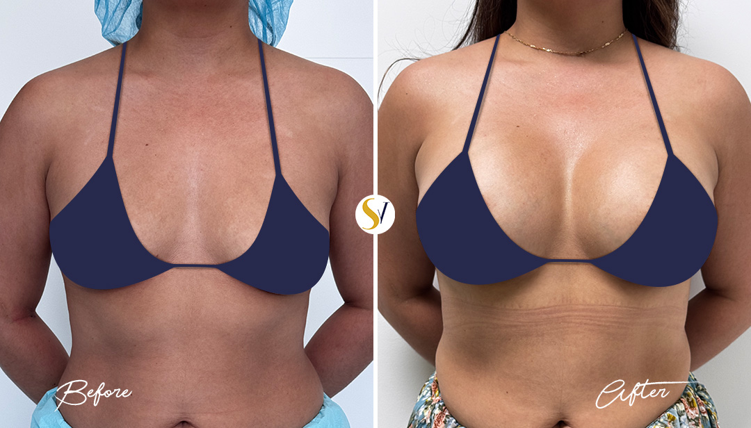 Breast Augmentation Before and After