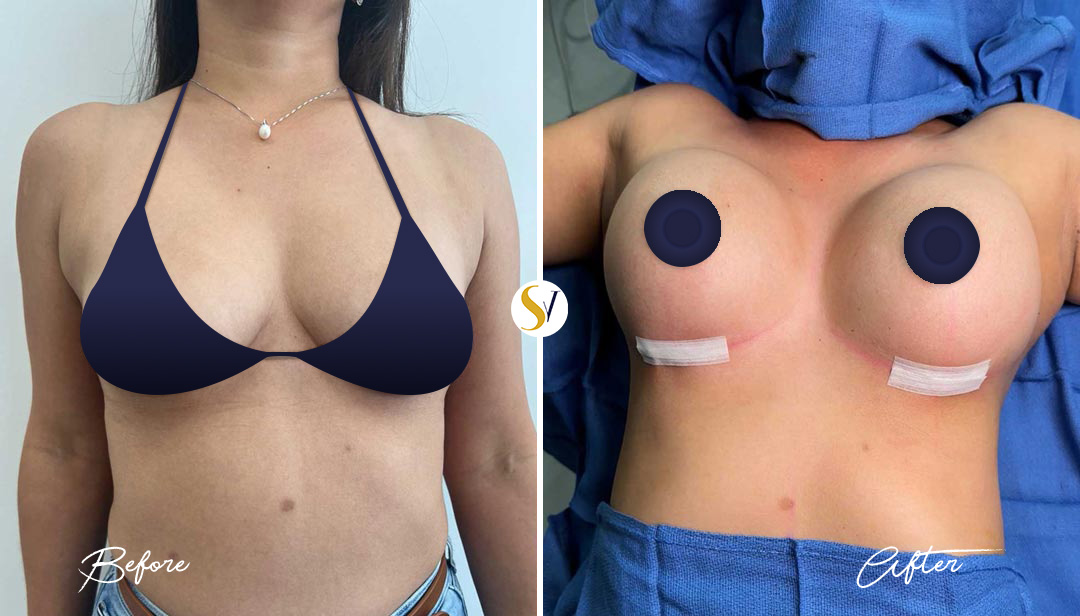 Breast Augmentation Before and After