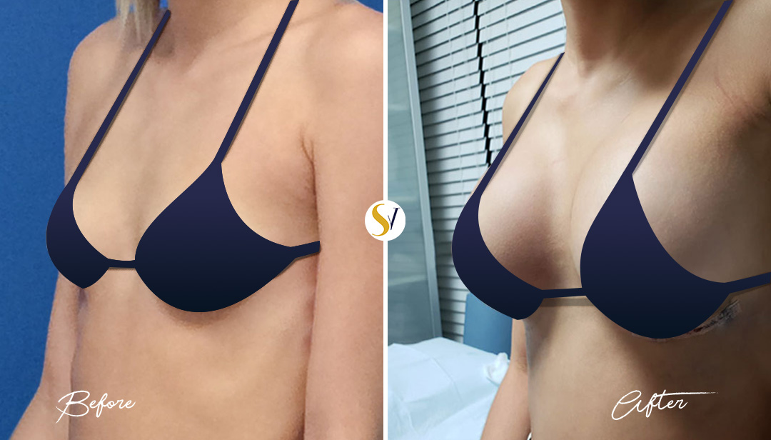 Breast Augmentation Before and After