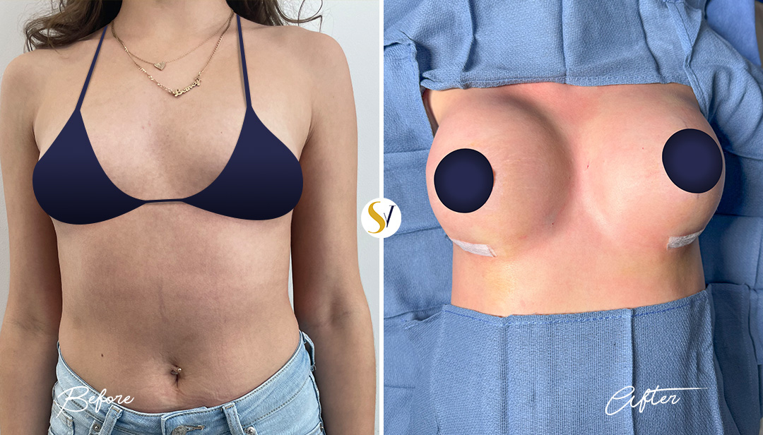 Breast Augmentation Before and After