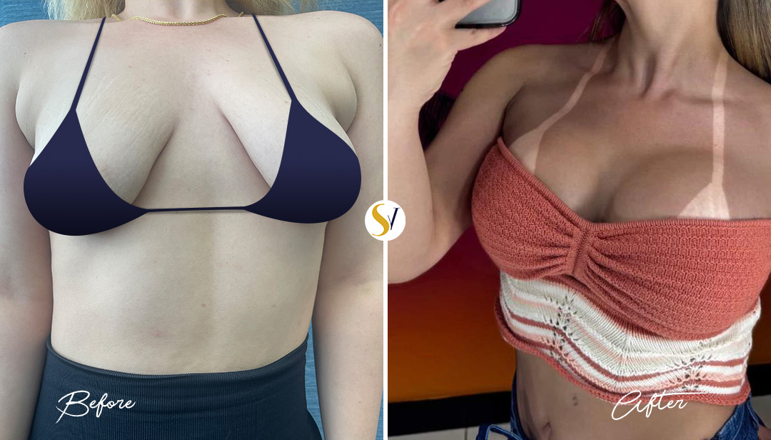 Breast Augmentation Before and After