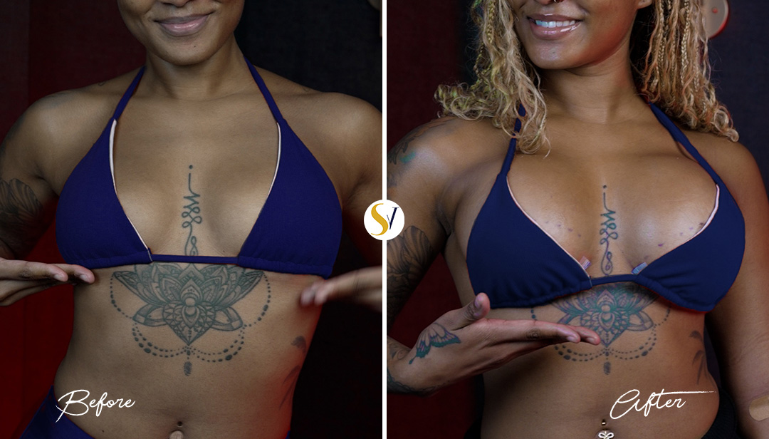 Breast Augmentation Before and After