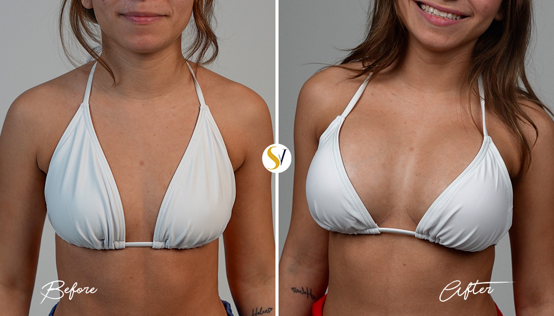 Breast Augmentation Before and After