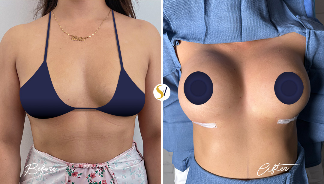 Breast Augmentation Before and After