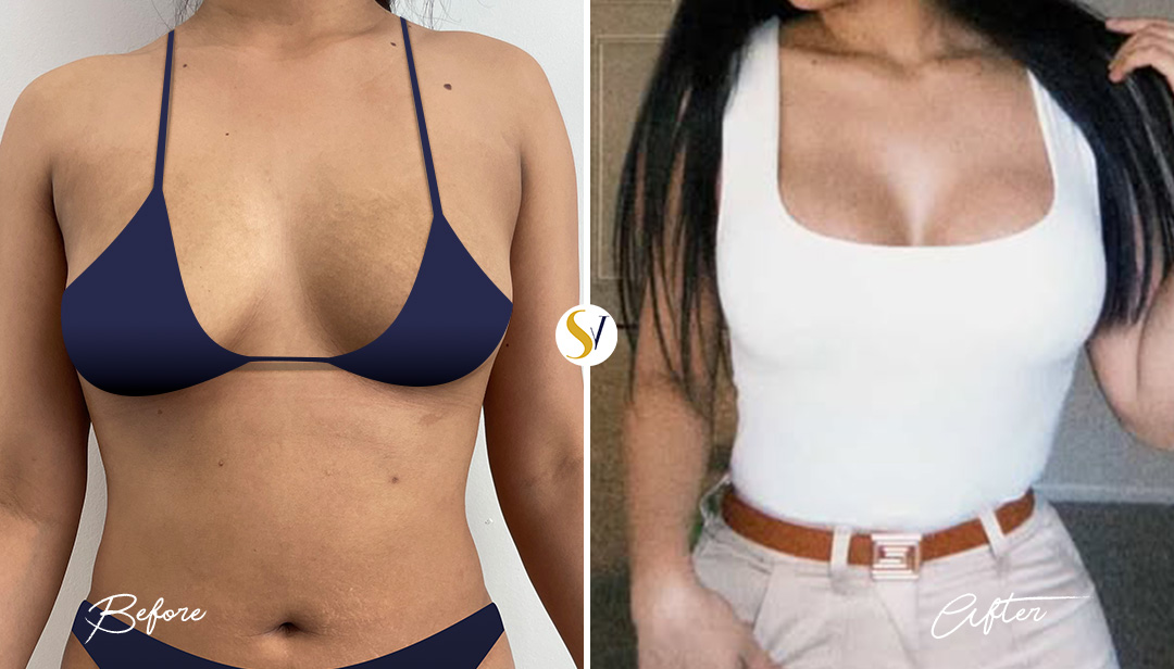 Breast Augmentation Before and After