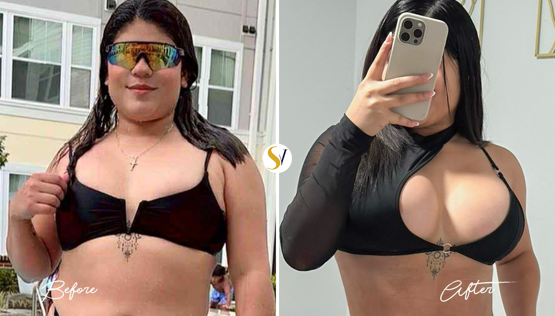 Breast Augmentation Before and After