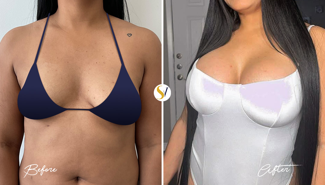 Breast Augmentation Before and After
