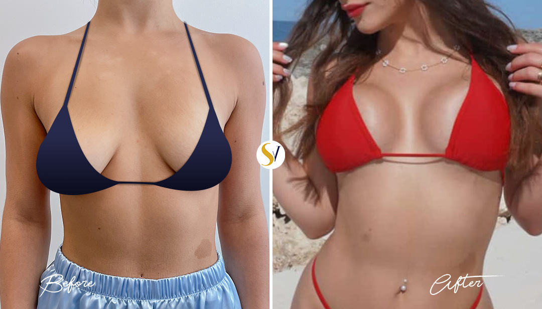 Breast Augmentation Before and After
