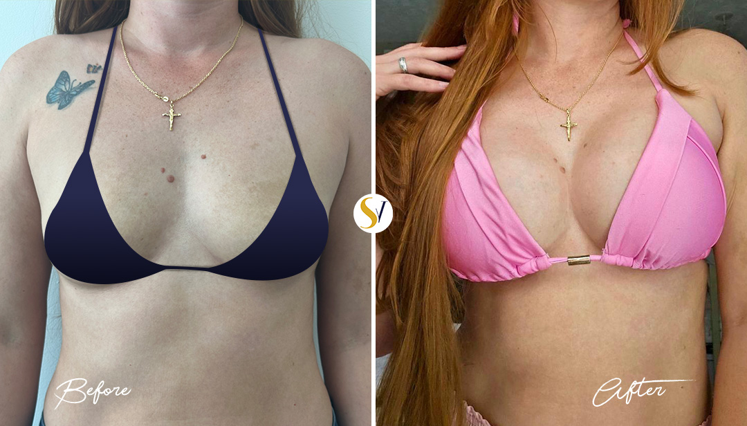 Breast Augmentation Before and After