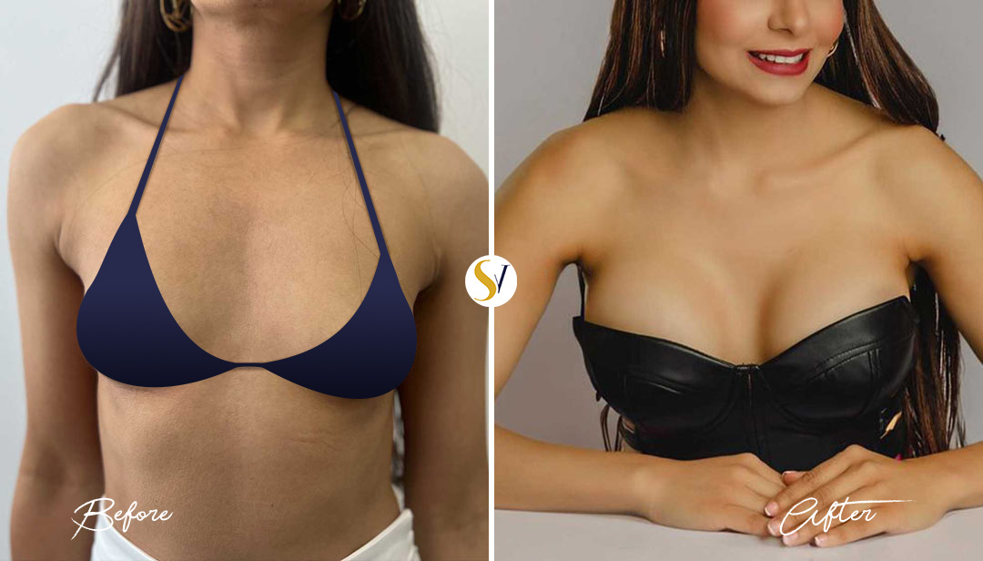 Breast Augmentation Before and After