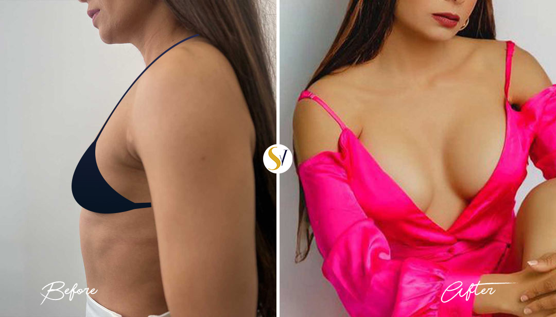 Breast Augmentation Before and After