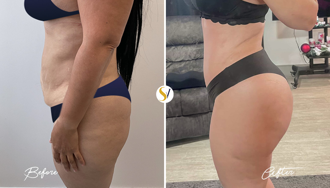 Brazilian Butt Lift Before and After