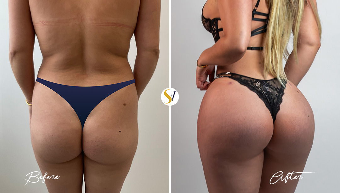 Brazilian Butt Lift Before and After