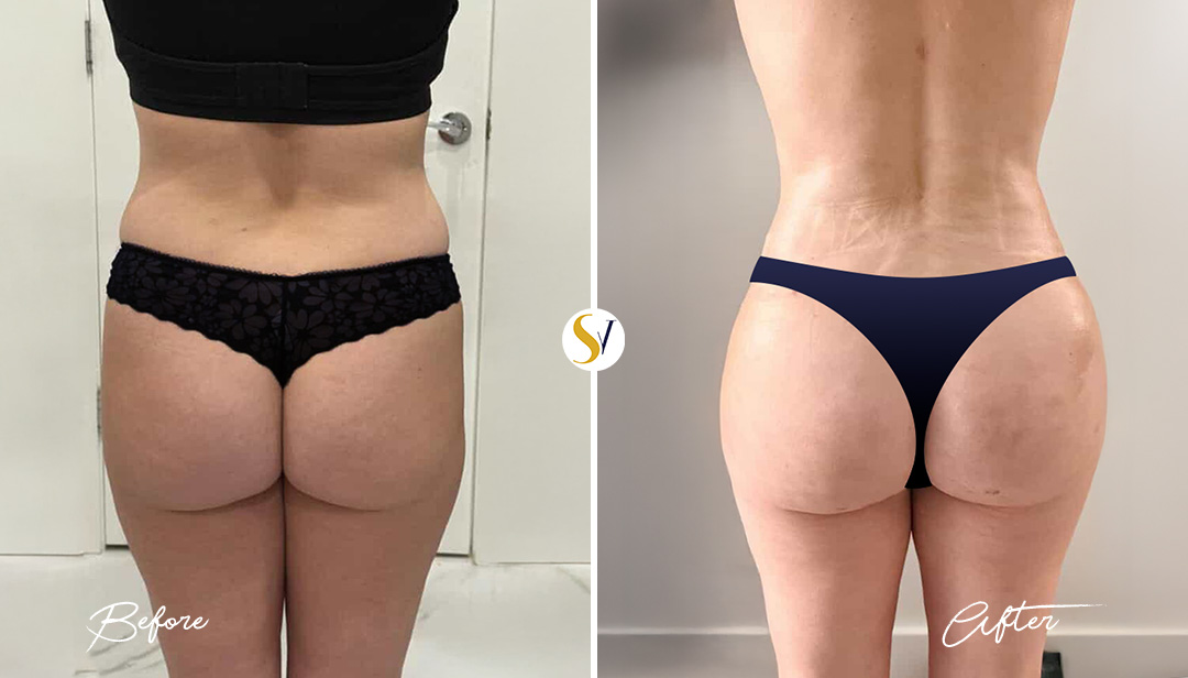Brazilian Butt Lift Before and After