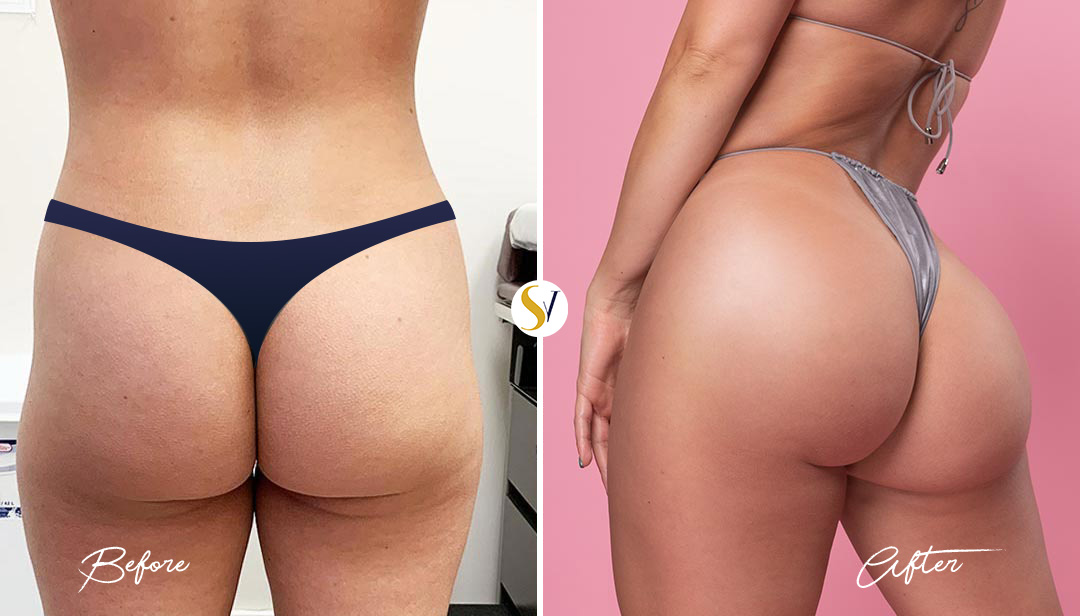 Brazilian Butt Lift Before and After
