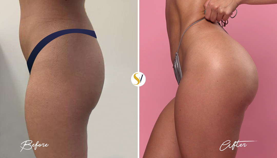 Brazilian Butt Lift Before and After