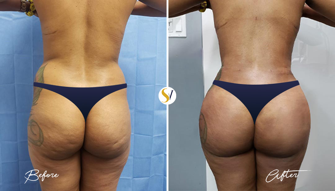 Brazilian Butt Lift Before and After