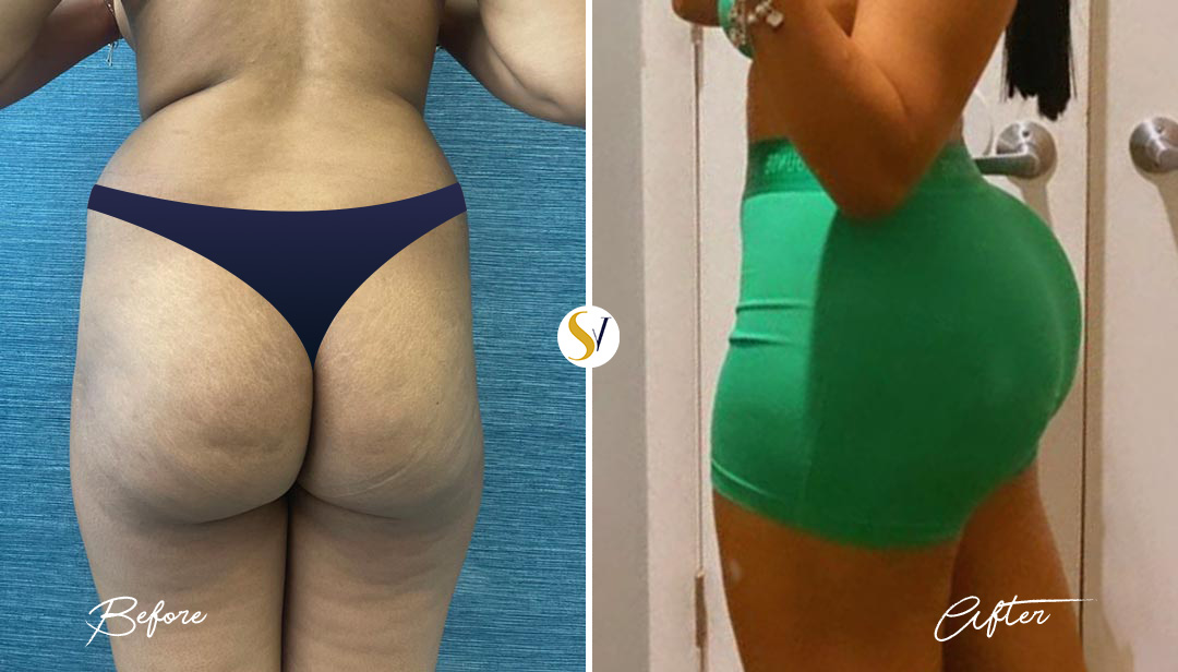 Brazilian Butt Lift Before and After