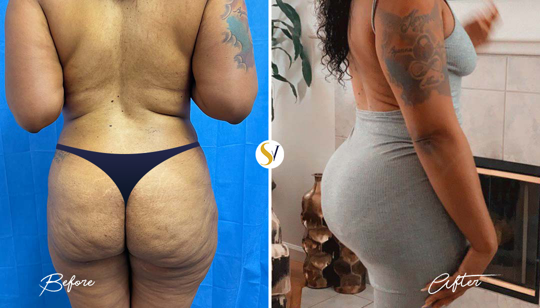 Brazilian Butt Lift Before and After