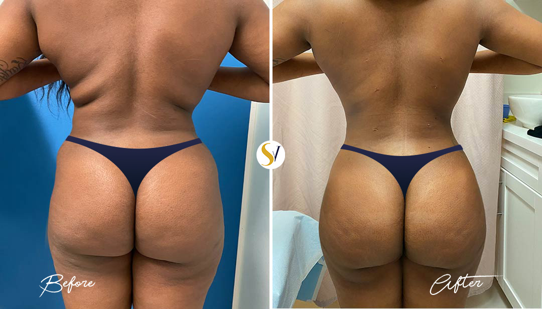 Brazilian Butt Lift Before and After