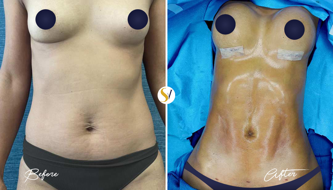 HD Liposuction Before and After
