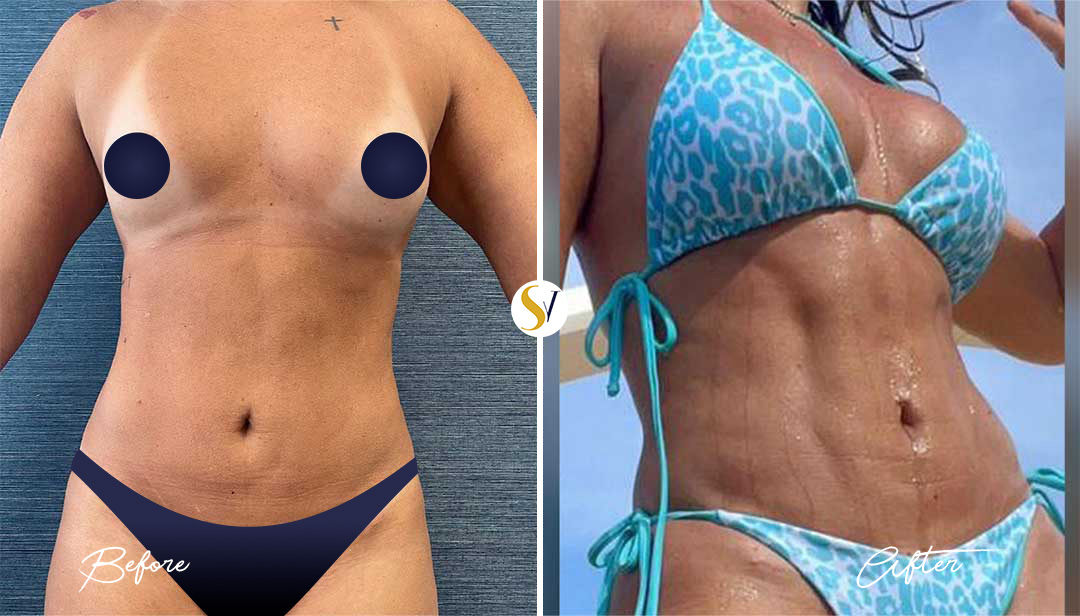 HD Liposuction Before and After