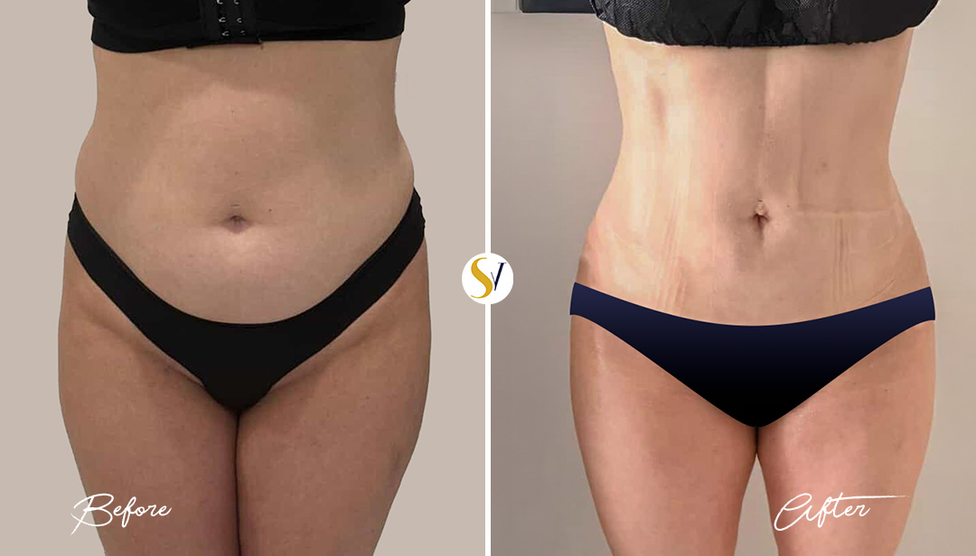Lipo 360 Before and After