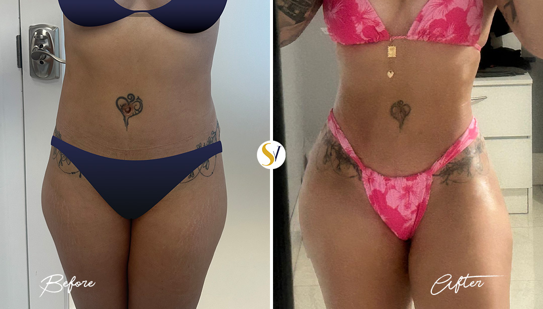 Lipo 360 Before and After