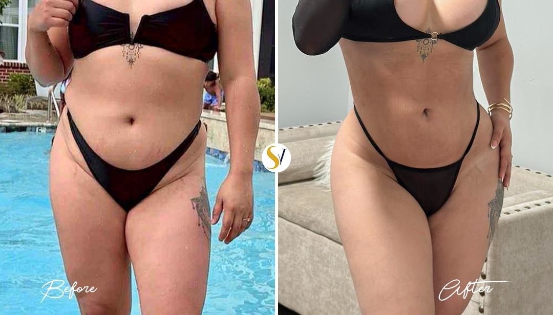 Lipo 360 Before and After