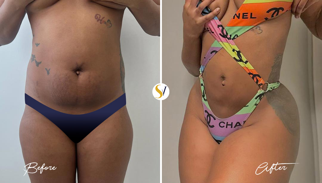 Lipo 360 Before and After