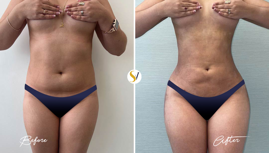 Lipo 360 Before and After