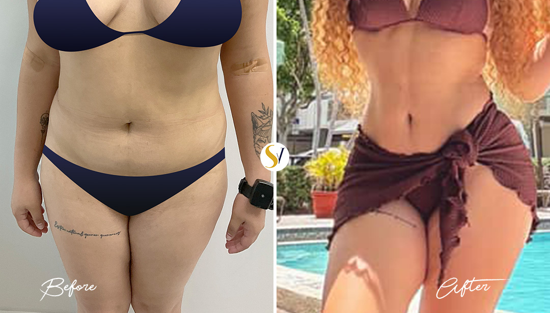 Lipo 360 Before and After