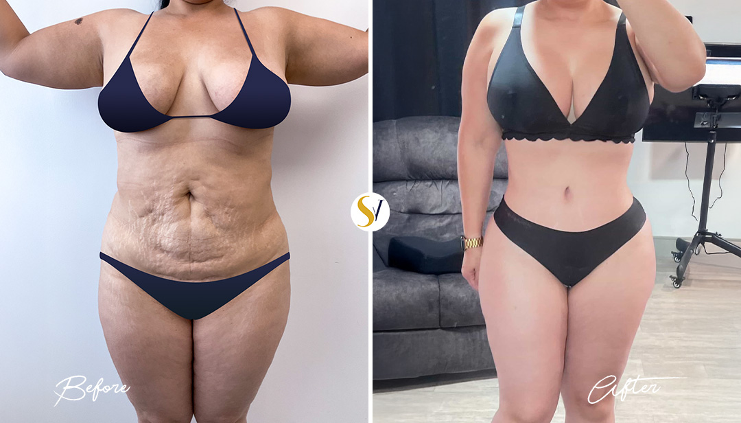 Mommy Makeover Before and After
