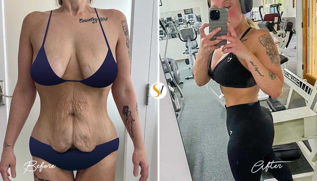 Mommy Makeover Before and After