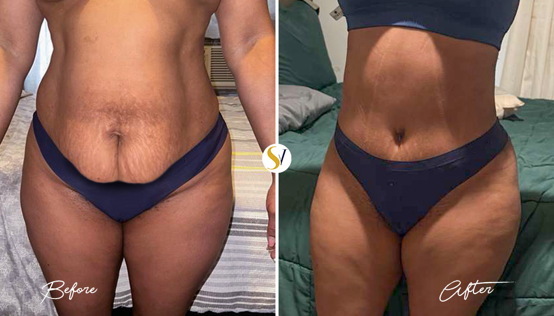 Tummy Tuck Before and After