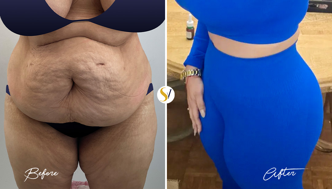 Tummy Tuck Before and After