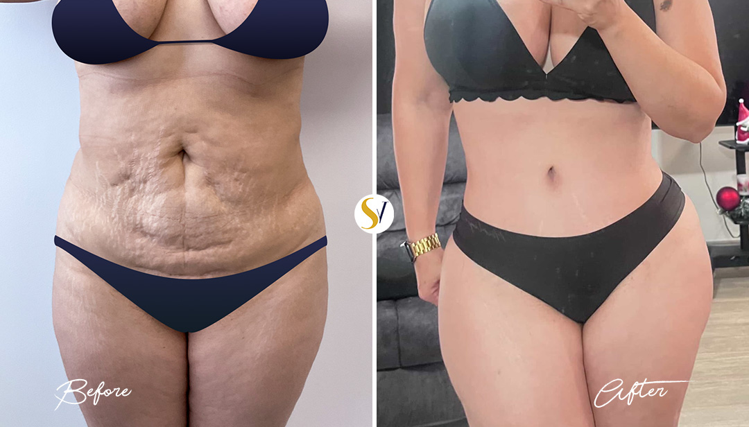 Tummy Tuck Before and After