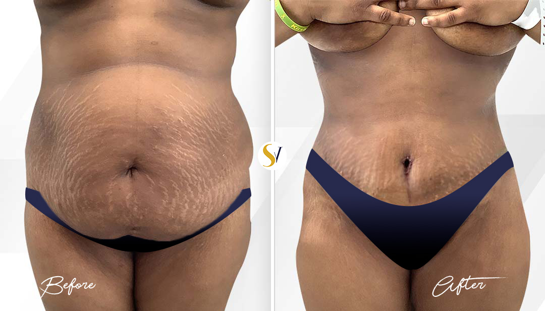 Tummy Tuck Before and After