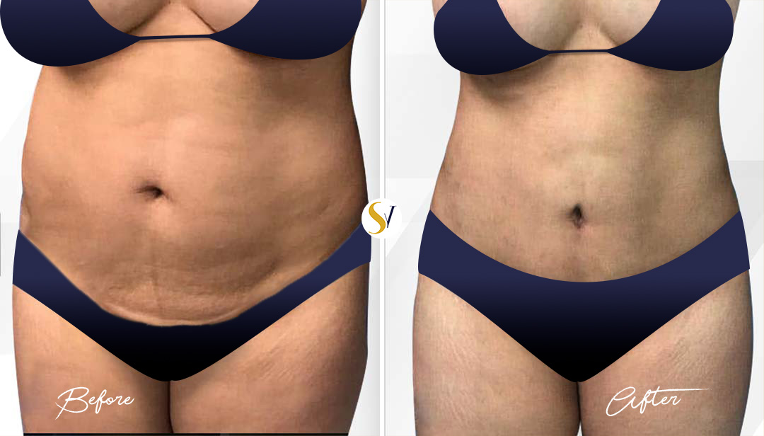 Tummy Tuck Before and After