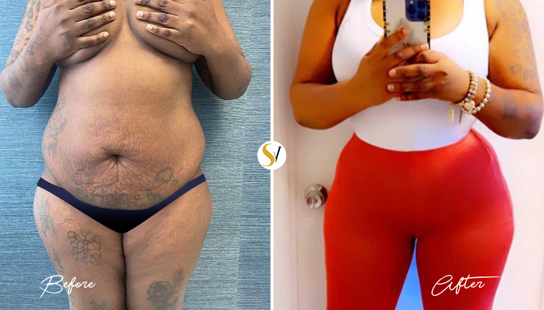 Tummy Tuck Before and After