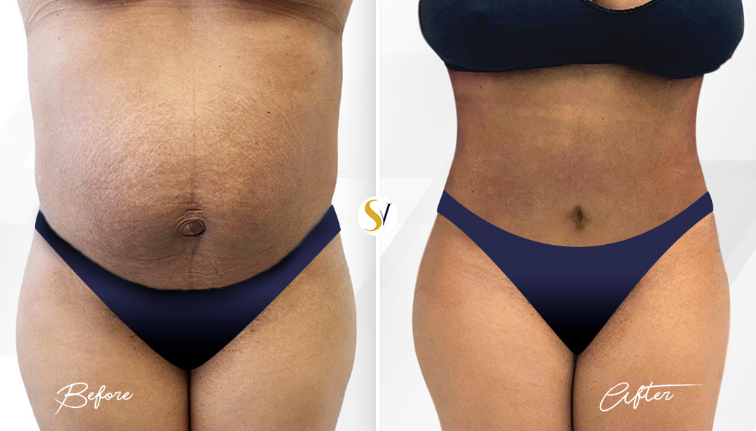 Tummy Tuck Before and After