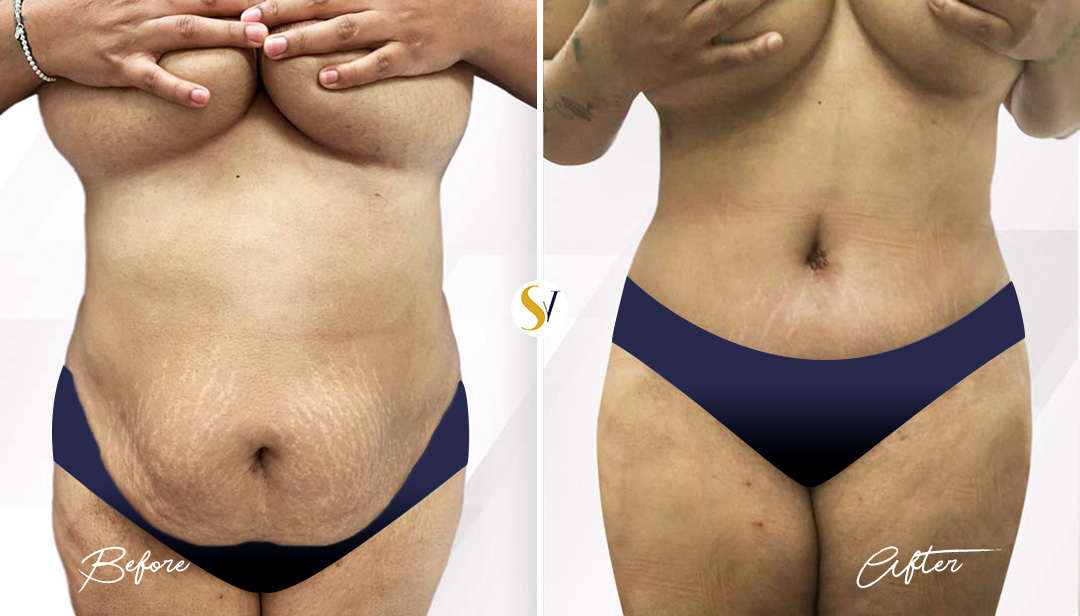 Tummy Tuck Before and After