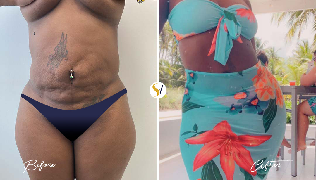 Tummy Tuck Before and After