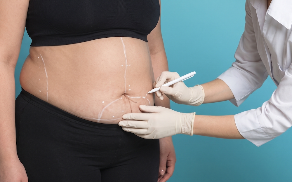 Bariatric Surgery Miami